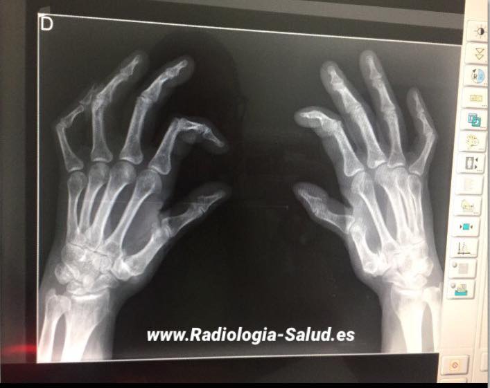 Dedo dislocado pulgar